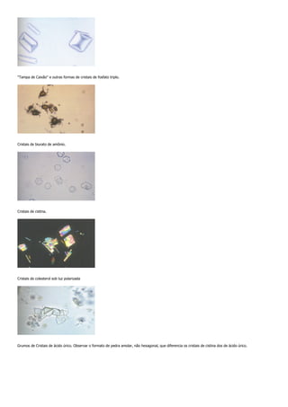 "Tampa de Caixão" e outras formas de cristais de fosfato triplo.




Cristais de biurato de amônio.




Cristais de cistina.




Cristais de colesterol sob luz polarizada




Grumos de Cristais de ácido úrico. Observar o formato de pedra amolar, não hexagonal, que diferencia os cristais de cistina dos de ácido úrico.
 