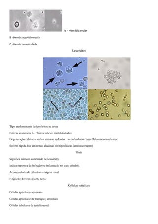A - Hemácia anular

B - Hemácia polidivercular

C - Hemácia espiculada

                                                      Leucócitos




Tipo predominante de leucócitos na urina

Esferas granulares (~ 12um) e núcleo multilobulado)

Degeneração celular – núcleo torna-se redondo     (confundindo com células mononucleares)

Sofrem rápida lise em urinas alcalinas ou hipotônicas (amostra recente)

                                                        Piúria

Significa número aumentado de leucócitos

Indica presença de infecção ou inflamação no trato urinário.

Acompanhada de cilindros – origem renal

Rejeição do transplante renal

                                                  Células epiteliais

Células epiteliais escamosas

Células epiteliais (de transição) uroteliais

Células tubulares de epitélio renal
 