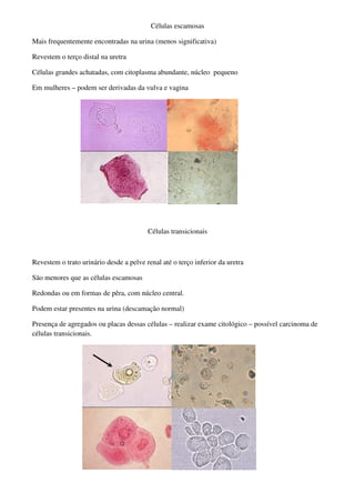 Células escamosas

Mais frequentemente encontradas na urina (menos significativa)

Revestem o terço distal na uretra

Células grandes achatadas, com citoplasma abundante, núcleo pequeno

Em mulheres – podem ser derivadas da vulva e vagina




                                         Células transicionais



Revestem o trato urinário desde a pelve renal até o terço inferior da uretra

São menores que as células escamosas

Redondas ou em formas de pêra, com núcleo central.

Podem estar presentes na urina (descamação normal)

Presença de agregados ou placas dessas células – realizar exame citológico – possível carcinoma de
células transicionais.
 