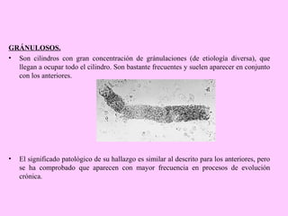 GRÁNULOSOS.
• Son cilindros con gran concentración de gránulaciones (de etiología diversa), que
llegan a ocupar todo el cilindro. Son bastante frecuentes y suelen aparecer en conjunto
con los anteriores.

•

El significado patológico de su hallazgo es similar al descrito para los anteriores, pero
se ha comprobado que aparecen con mayor frecuencia en procesos de evolución
crónica.

 