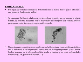 ERITROCITARIOS.
• Son aquellos cilindros compuestos de hematíes más o menos densos que se adhieren a
una sustancia fundamental hialina.
•

Se reconocen fácilmente al observar un acúmulo de hematíes que se mueven al mismo
tiempo, se confirma buscando con el micrómetro los márgenes del cilindro. Pueden
presentar un color ligeramente rojo-amarillo o pardo.

•

No se observan en sujetos sanos, por lo que su hallazgo tiene valor patológico, indican
que la hematuria es de origen renal, siendo pues un hallazgo importante y fácil de ver.
Suelen aparecer en la glomerulonefritis aguda o crónica y en otras enfermedades
sistémicas ( LES, panarteritis nodosa, …).

 