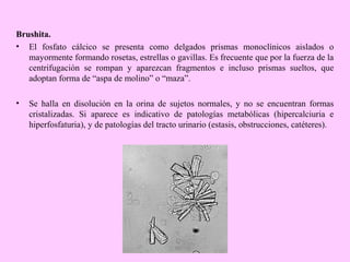 Brushita.
• El fosfato cálcico se presenta como delgados prismas monoclínicos aislados o
mayormente formando rosetas, estrellas o gavillas. Es frecuente que por la fuerza de la
centrifugación se rompan y aparezcan fragmentos e incluso prismas sueltos, que
adoptan forma de “aspa de molino” o “maza”.
•

Se halla en disolución en la orina de sujetos normales, y no se encuentran formas
cristalizadas. Si aparece es indicativo de patologías metabólicas (hipercalciuria e
hiperfosfaturia), y de patologías del tracto urinario (estasis, obstrucciones, catéteres).

 