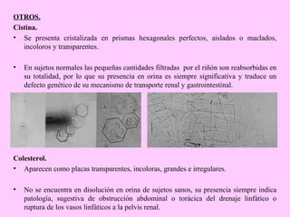OTROS.
Cistina.
• Se presenta cristalizada en prismas hexagonales perfectos, aislados o maclados,
incoloros y transparentes.
•

En sujetos normales las pequeñas cantidades filtradas por el riñón son reabsorbidas en
su totalidad, por lo que su presencia en orina es siempre significativa y traduce un
defecto genético de su mecanismo de transporte renal y gastrointestinal.

Colesterol.
• Aparecen como placas transparentes, incoloras, grandes e irregulares.
•

No se encuentra en disolución en orina de sujetos sanos, su presencia siempre indica
patología, sugestiva de obstrucción abdominal o torácica del drenaje linfático o
ruptura de los vasos linfáticos a la pelvis renal.

 