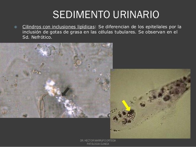 Gotas De Grasa En Sedimento Urinario es.slideshare.net