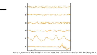 Sedline Monitor Waveforms Sedline y narcotrend.pptx