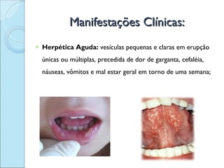 Manifestações Clínicas:
   Herpética Aguda: vesículas pequenas e claras em erupção
    únicas ou múltiplas, precedida de dor de garganta, cefaléia,
    náuseas, vômitos e mal estar geral em torno de uma semana;
 