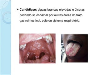  Candidíase: placas brancas elevadas e úlceras
  podendo se espalhar por outras áreas do trato
  gastrointestinal, pele ou sistema respiratório;
 