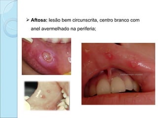  Aftosa: lesão bem circunscrita, centro branco com
  anel avermelhado na periferia;
 
