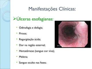 Manifestações Clínicas:
Úlceras esofagianas:
    Odinofagia e disfagia;
    Pirose;
    Regurgitação ácida;
    Dor na região esternal;
    Hematêmese (sangue cor viva);
    Melena;
    Sangue oculto nas fezes;
 