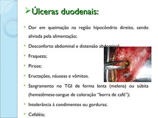 Úlceras duodenais:
   Dor em queimação na região hipocôndrio direito, sendo
    aliviada pela alimentação;
   Desconforto abdominal e distensão abdominal;
   Fraqueza;
   Pirose;
   Eructações, náuseas e vômitos.
   Sangramento no TGI de forma lenta (melena) ou súbita
    (hematêmese-sangue de coloração “borra de café”);
   Intolerância à condimentos ou gorduras;
   Cefaléia;
 