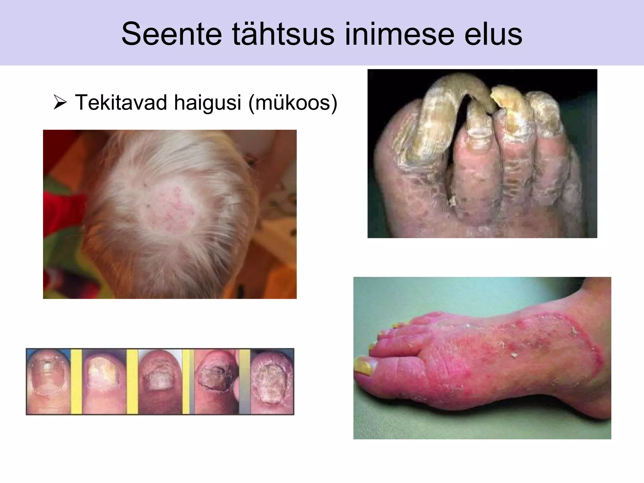 Seente tähtsus inimese elus 
 Tekitavad haigusi (mükoos) 
