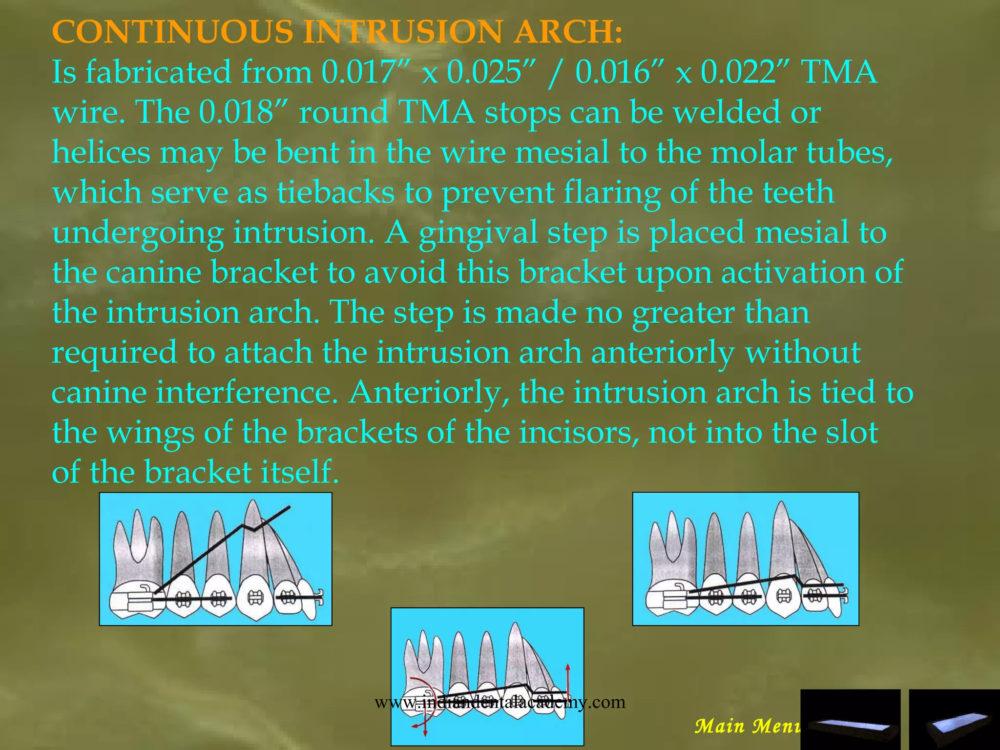 CONTINUOUS INTRUSION ARCH:
Is fabricated from 0.017” x 0.025” / 0.016” x 0.022” TMA
wire. The 0.018” round TMA stops can be welded or
helices may be bent in the wire mesial to the molar tubes,
which serve as tiebacks to prevent flaring of the teeth
undergoing intrusion. A gingival step is placed mesial to
the canine bracket to avoid this bracket upon activation of
the intrusion arch. The step is made no greater than
required to attach the intrusion arch anteriorly without
canine interference. Anteriorly, the intrusion arch is tied to
the wings of the brackets of the incisors, not into the slot
of the bracket itself.
Main Menu
www.indiandentalacademy.com
 