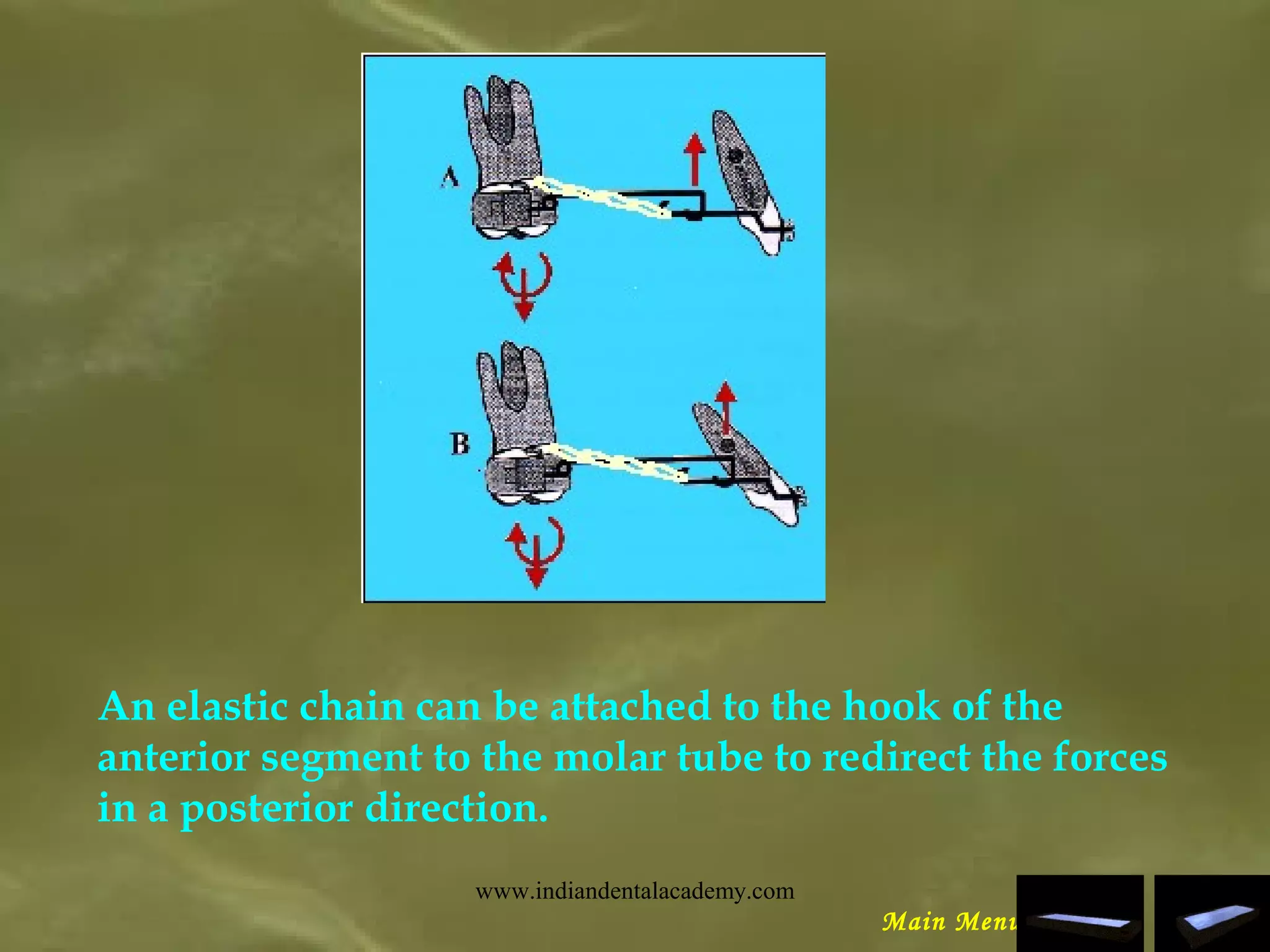 An elastic chain can be attached to the hook of the
anterior segment to the molar tube to redirect the forces
in a posterior direction.
Main Menu
www.indiandentalacademy.com
 