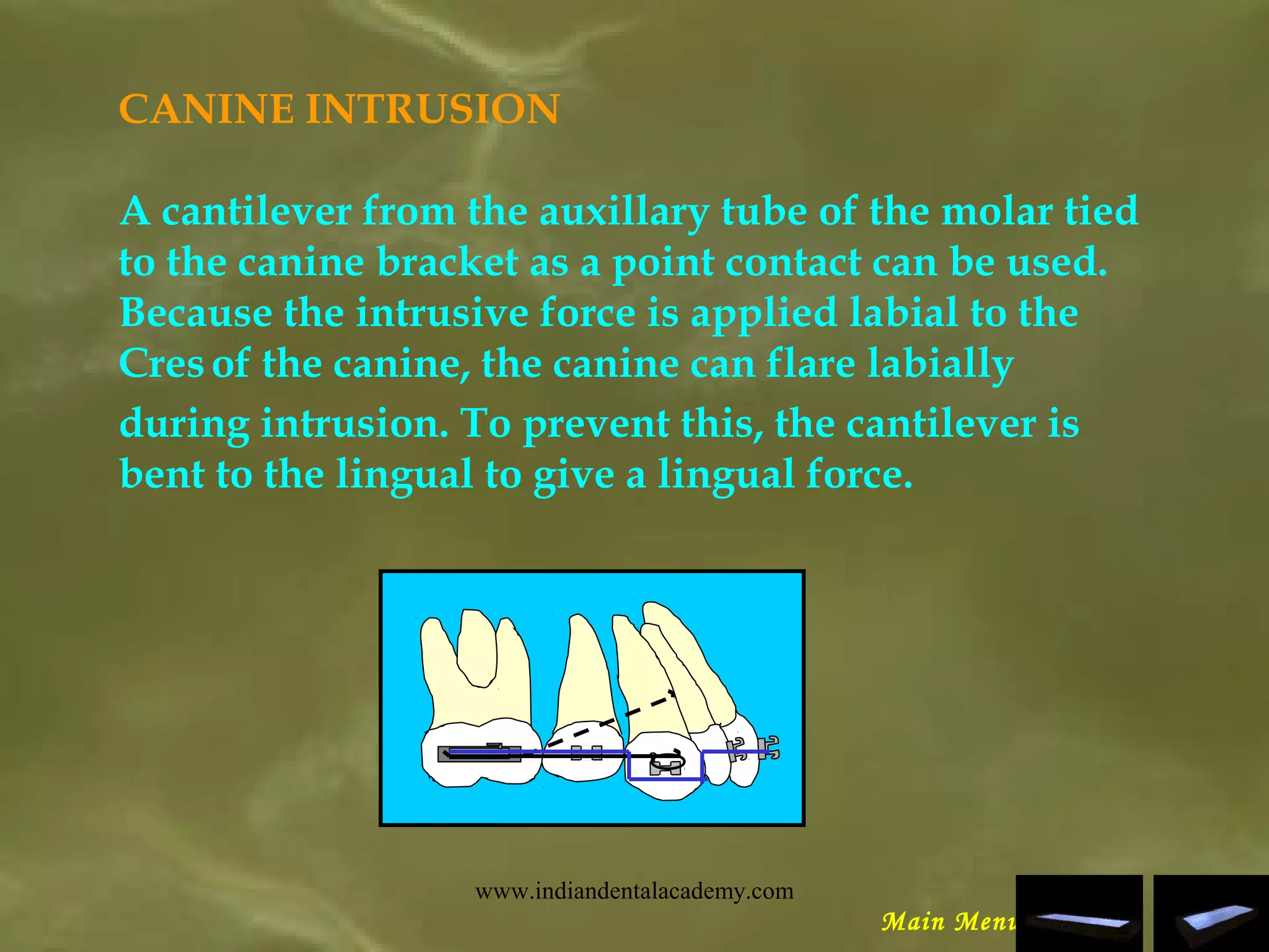CANINE INTRUSION
A cantilever from the auxillary tube of the molar tied
to the canine bracket as a point contact can be used.
Because the intrusive force is applied labial to the
Cresof the canine, the canine can flare labially
during intrusion. To prevent this, the cantilever is
bent to the lingual to give a lingual force.
Main Menu
www.indiandentalacademy.com
 