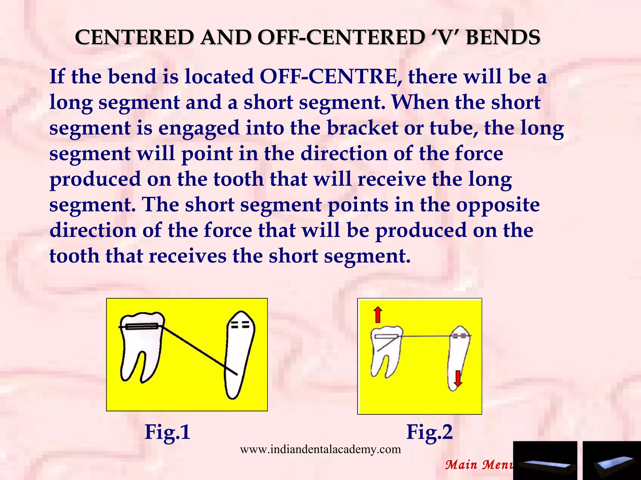 CENTERED AND OFF-CENTERED ‘V’ BENDSCENTERED AND OFF-CENTERED ‘V’ BENDS
If the bend is located OFF-CENTRE, there will be a
long segment and a short segment. When the short
segment is engaged into the bracket or tube, the long
segment will point in the direction of the force
produced on the tooth that will receive the long
segment. The short segment points in the opposite
direction of the force that will be produced on the
tooth that receives the short segment.
Fig.1 Fig.2
Main Menu
www.indiandentalacademy.com
 