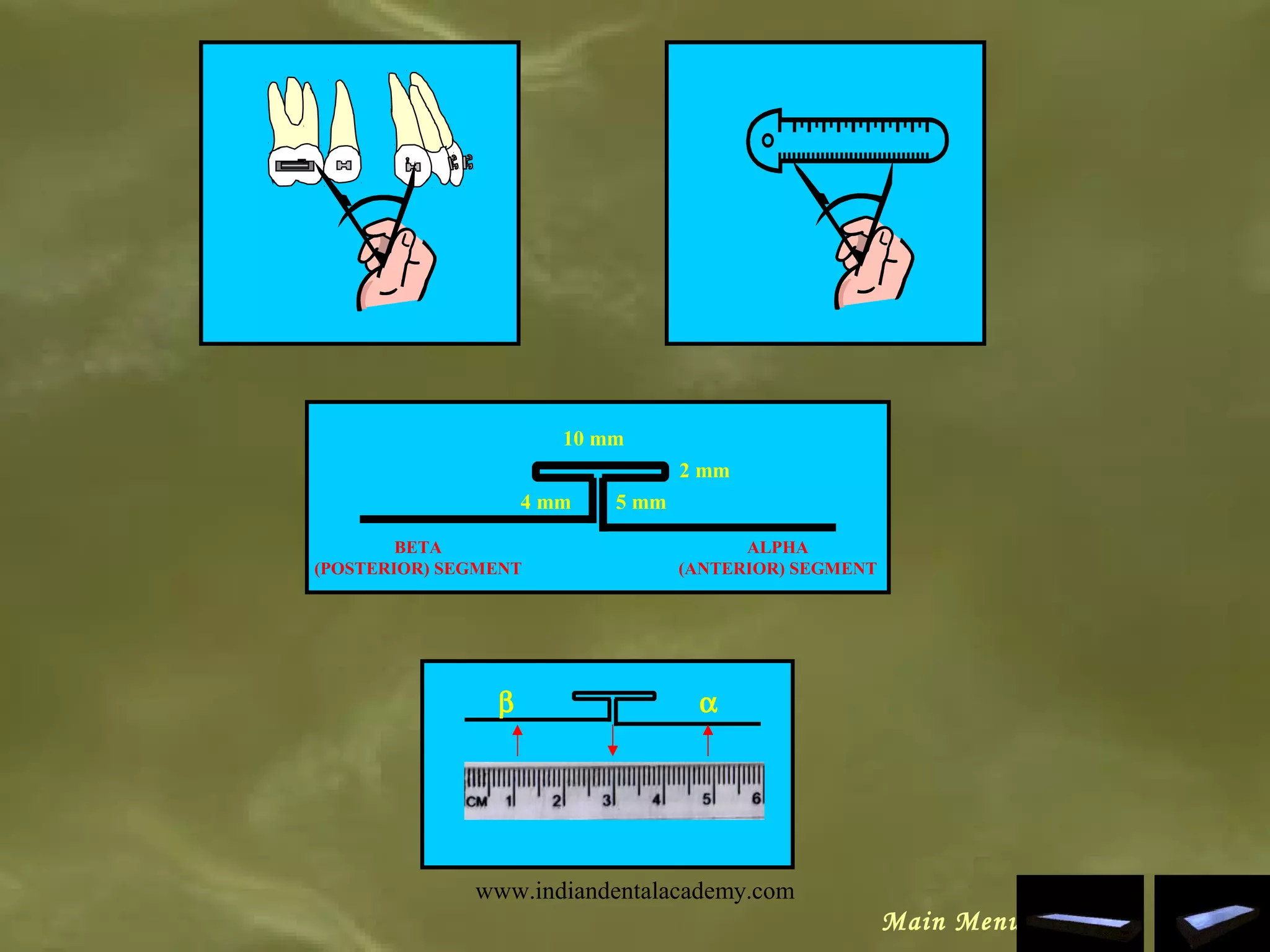 αβ
10 mm
5 mm
2 mm
4 mm
ALPHA
(ANTERIOR) SEGMENT
BETA
(POSTERIOR) SEGMENT
Main Menu
www.indiandentalacademy.com
 