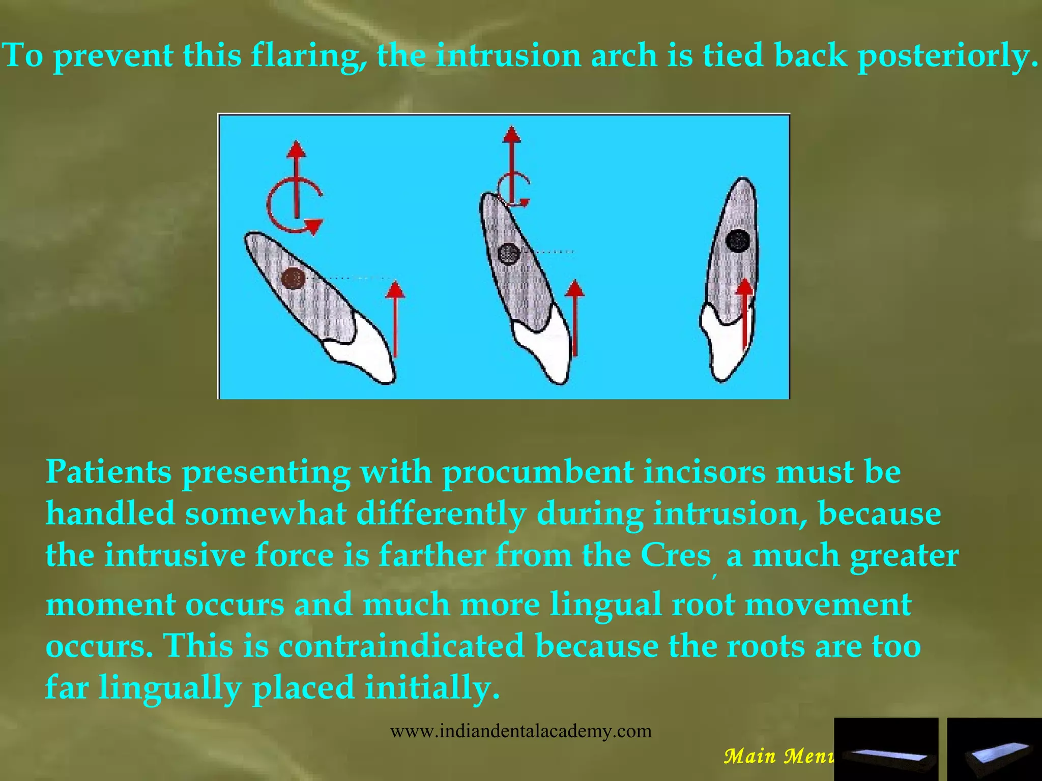 To prevent this flaring, the intrusion arch is tied back posteriorly.
Patients presenting with procumbent incisors must be
handled somewhat differently during intrusion, because
the intrusive force is farther from the Cres,
a much greater
moment occurs and much more lingual root movement
occurs. This is contraindicated because the roots are too
far lingually placed initially.
Main Menu
www.indiandentalacademy.com
 