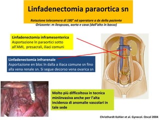 Intraperitoneale Chirurgia mininvasiva in ginecologia oncologica: Linfadenectomia ...