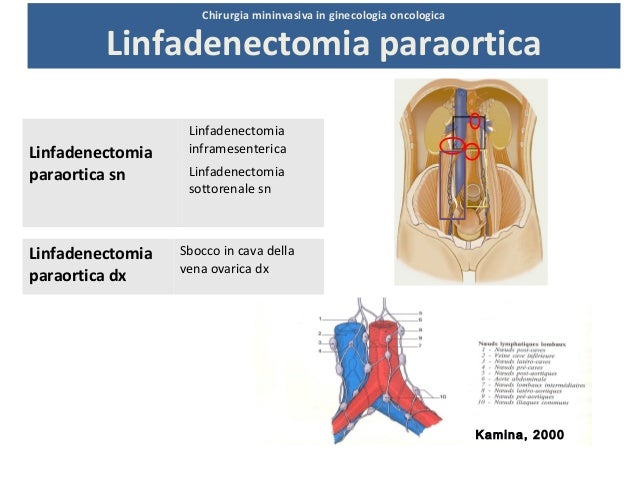 Chirurgia mininvasiva in ginecologia oncologica: Linfadenectomia intr…