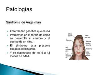 Patologías
Síndrome de Angelman
 Enfermedad genética que causa
 Problemas en la forma de como
se desarrolla el cerebro y el
cuerpo de un niño.
 El síndrome esta presente
desde el nacimiento.
 Y se diagnostica de los 6 a 12
meses de edad.
 