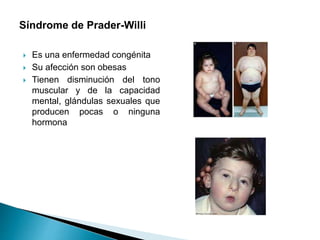 Síndrome de Prader-Willi
 Es una enfermedad congénita
 Su afección son obesas
 Tienen disminución del tono
muscular y de la capacidad
mental, glándulas sexuales que
producen pocas o ninguna
hormona
 