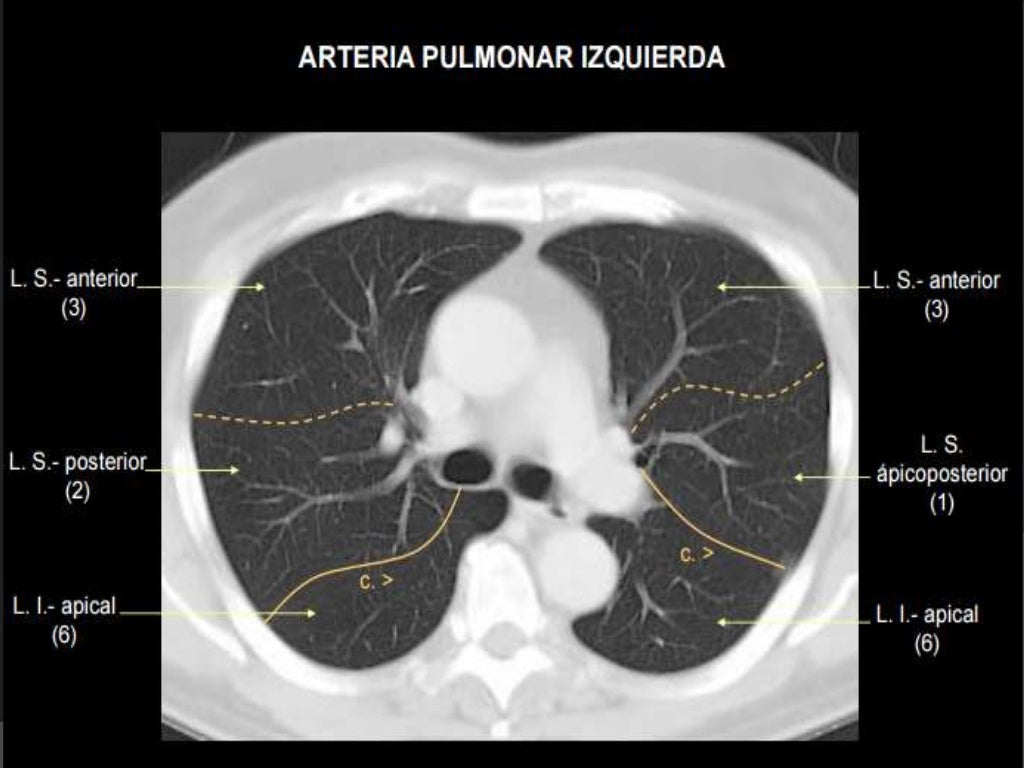 Segmentacion pulmonar tac Segmentacion pulmonar tac