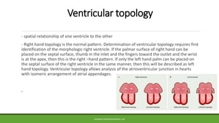 Ventricular topology
- spatial relationship of one ventricle to the other
- Right hand topology is the normal pattern. Det...