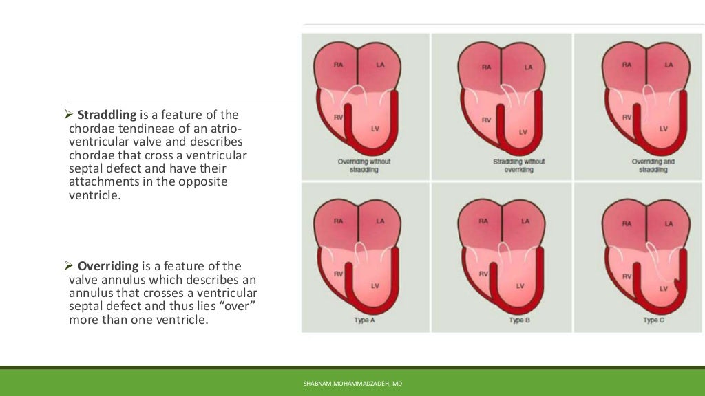 Segmental approach in congenital heart disease [autosaved].pptx 2.ppt…