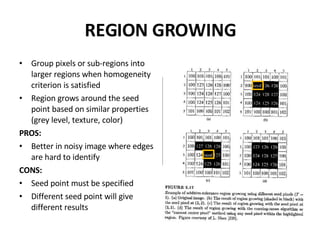 REGION GROWING Group pixels or sub-regions into larger regions when homogeneity criterion is satisfied  Region grows around the seed point based on similar properties (grey level, texture, color) PROS: Better in noisy image where edges are hard to identify CONS: Seed point must be specified Different seed point will give different results PIXEL AGGREGATION: Homogeneity criteria: The difference between 2 pixel values is less than or equal to 5 Horizontal, vertical, diagonal 10 10 10 10 10 10 10 10 10 10 69 70 10 10 59 10 60 64 59 56 60 10 59 10 60 70 10 62 10 60 59 65 67 10 65 10 10 10 10 10 10 10 10 10 10 10 10 10 10 