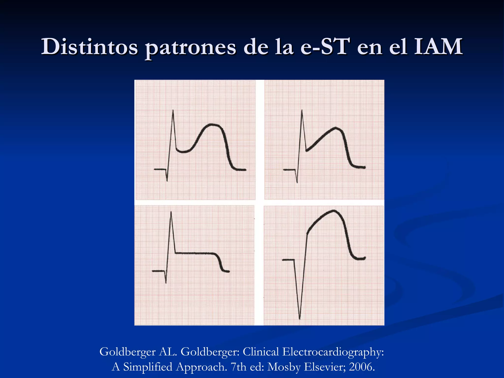 Distintos patrones de la e-ST en el IAM Goldberger AL. Goldberger: Clinical Electrocardiography:  A Simplified Approach. 7th ed: Mosby Elsevier; 2006. 