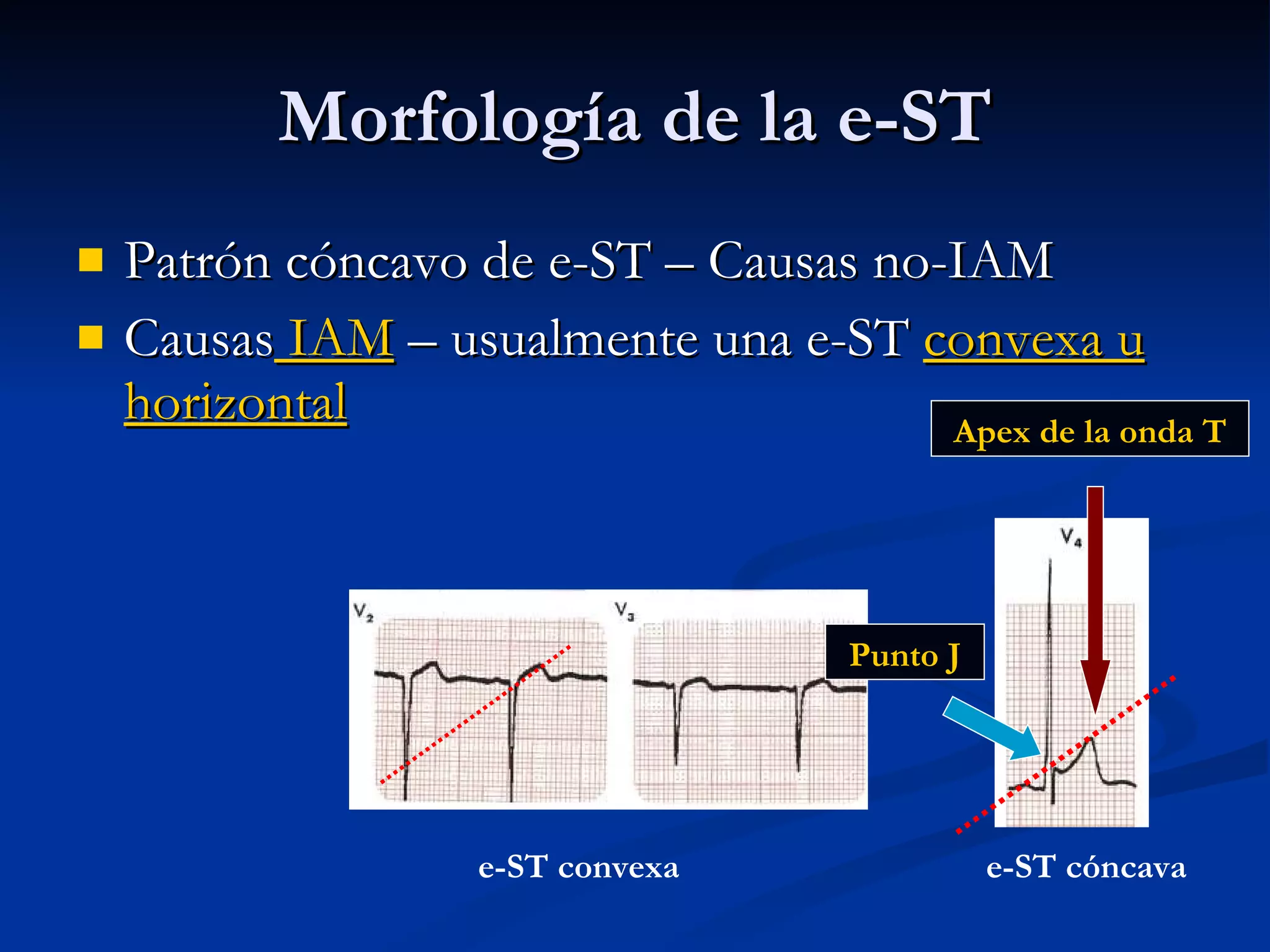 Morfología de la e-ST Patrón cóncavo de e-ST – Causas no-IAM Causas  IAM  – usualmente una e-ST  convexa u horizontal Punto J Apex de la onda T e-ST cóncava e-ST convexa 