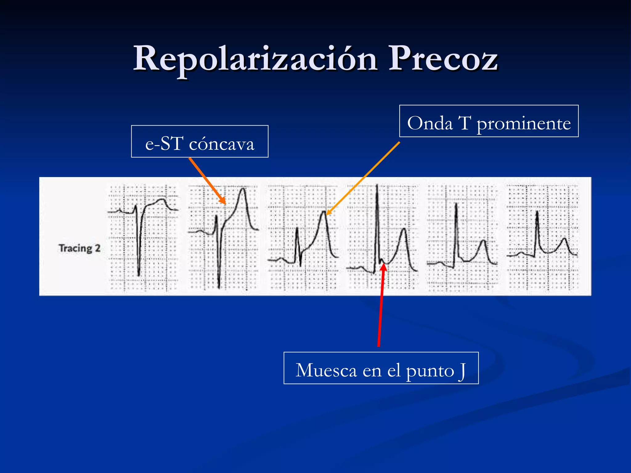Repolarización Precoz Muesca en el punto J e-ST cóncava Onda T prominente 