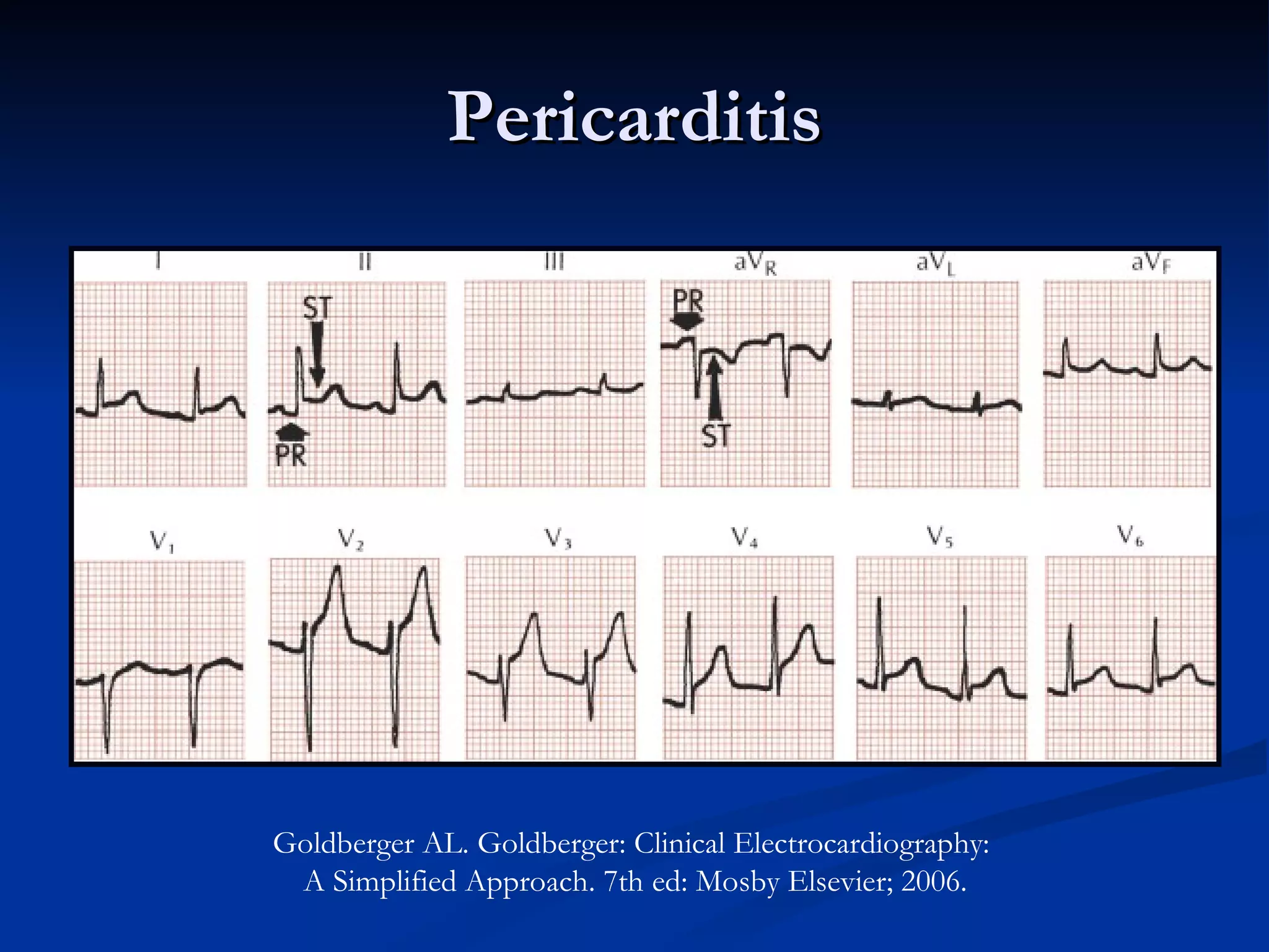 Pericarditis Goldberger AL. Goldberger: Clinical Electrocardiography:  A Simplified Approach. 7th ed: Mosby Elsevier; 2006. 