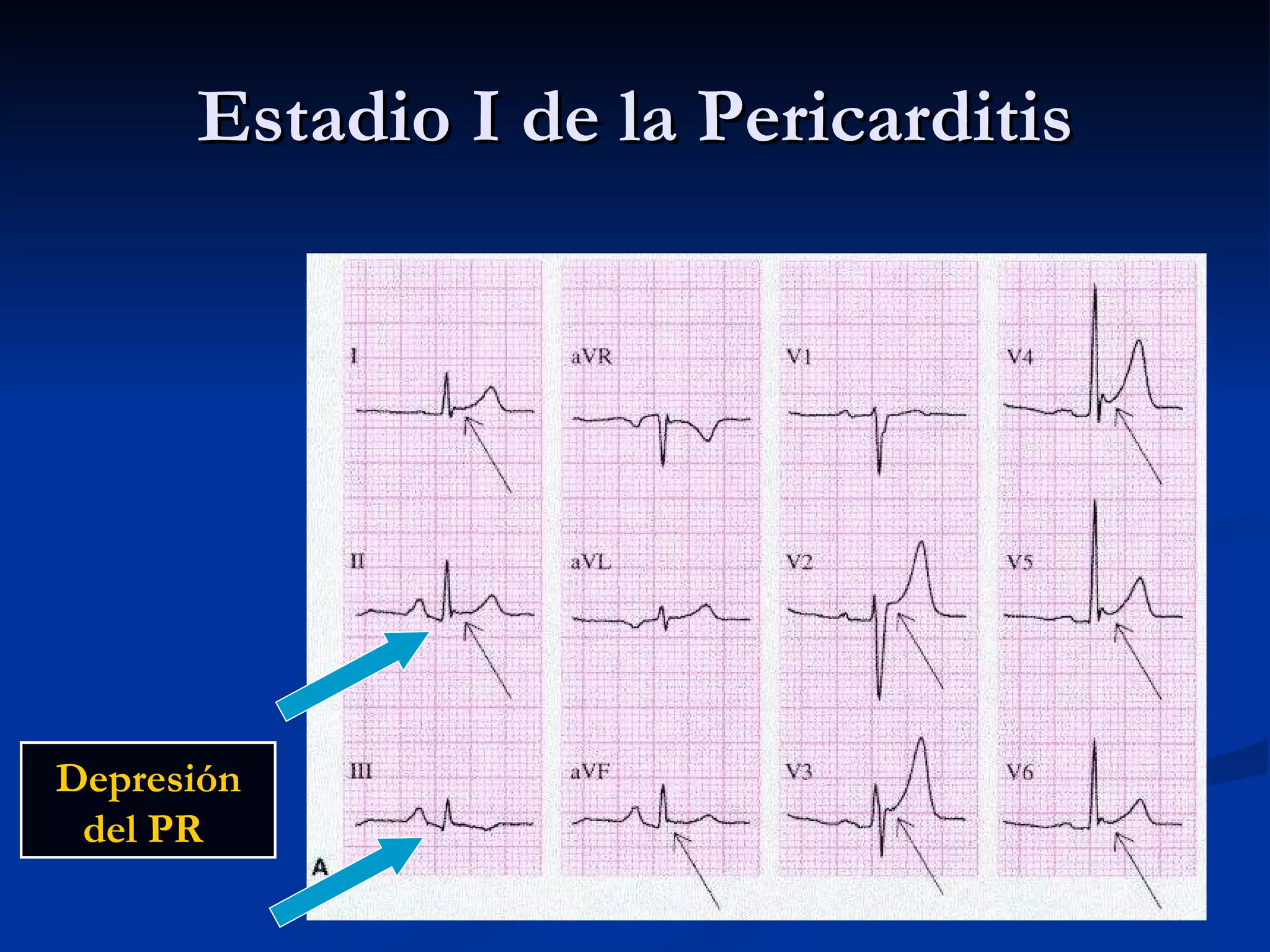 Estadio I de la Pericarditis Depresión del PR  