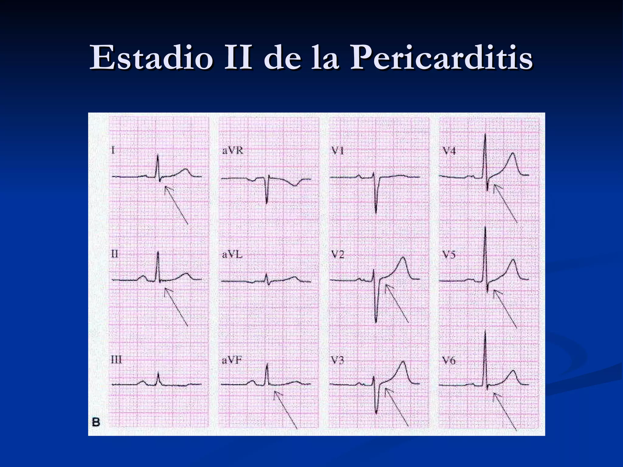 Estadio II de la Pericarditis 