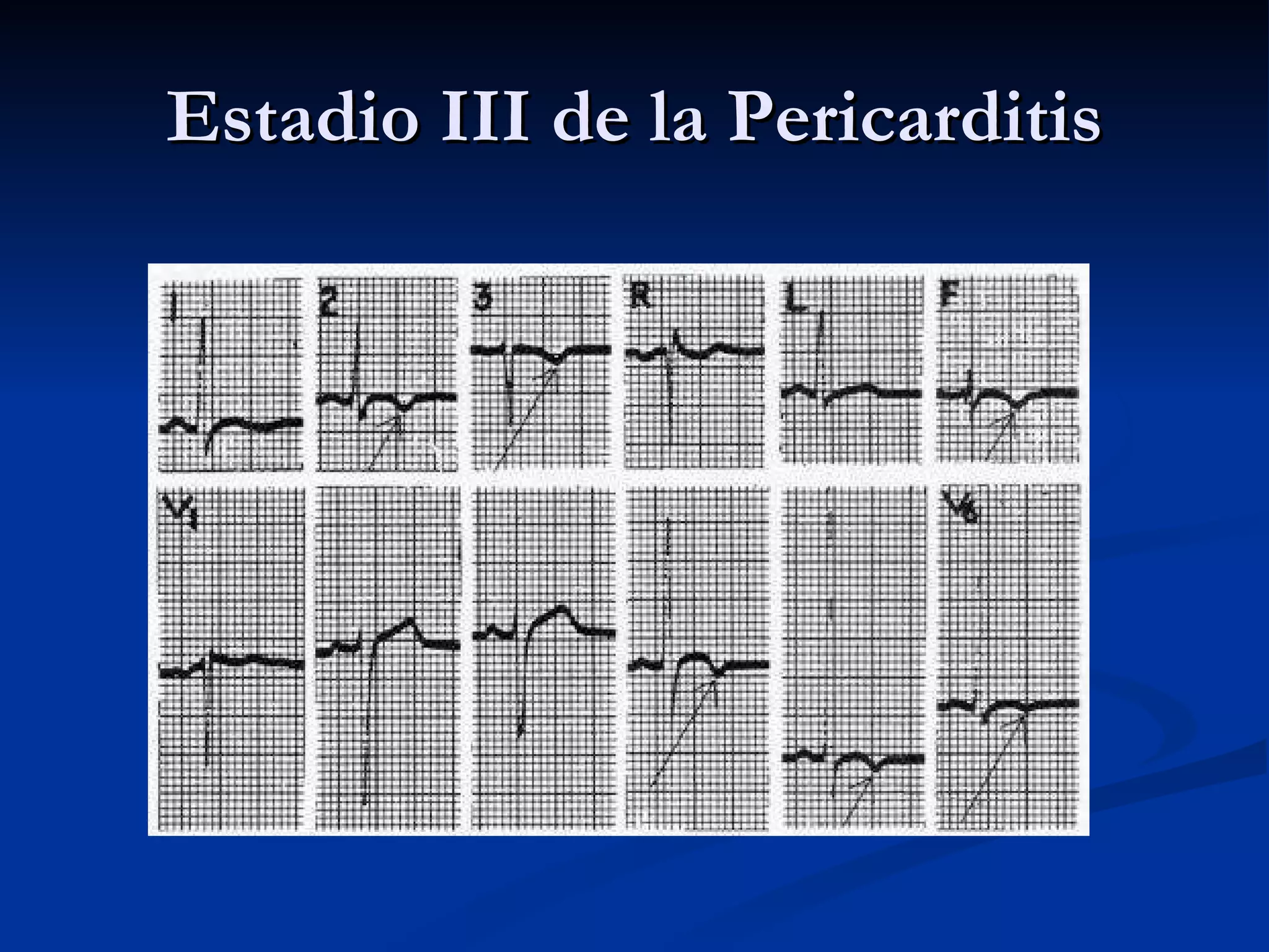 Estadio III de la Pericarditis 