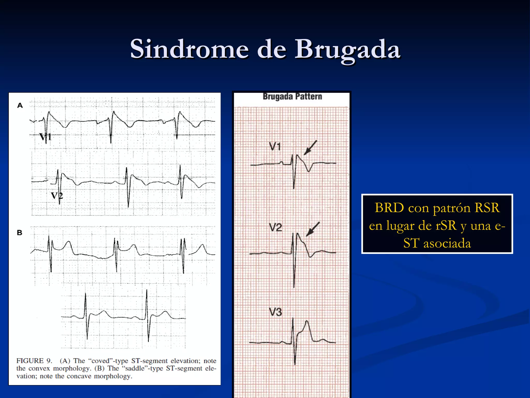 Sindrome de Brugada BRD con patrón RSR en lugar de rSR y una e-ST asociada 