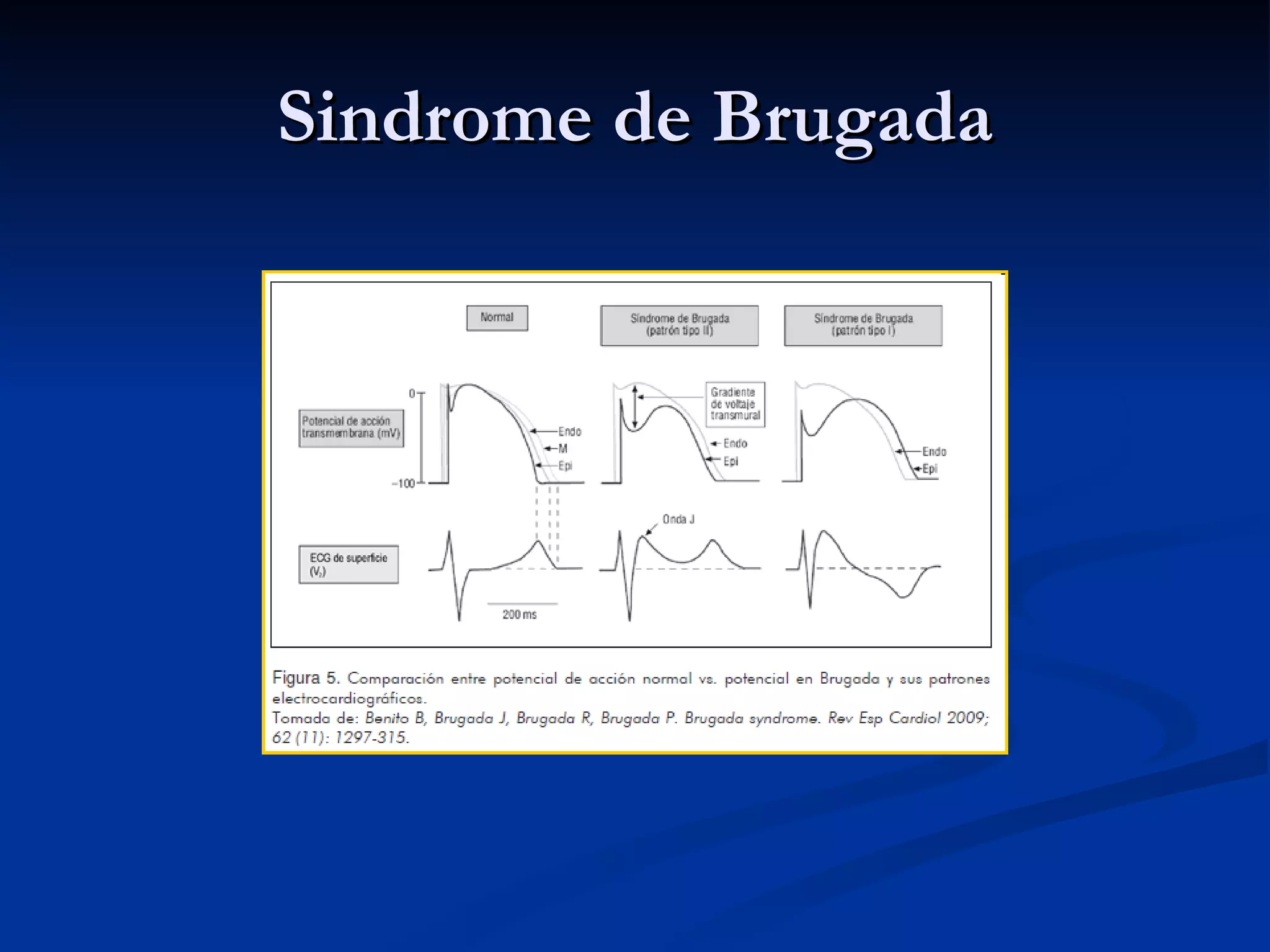 Sindrome de Brugada 