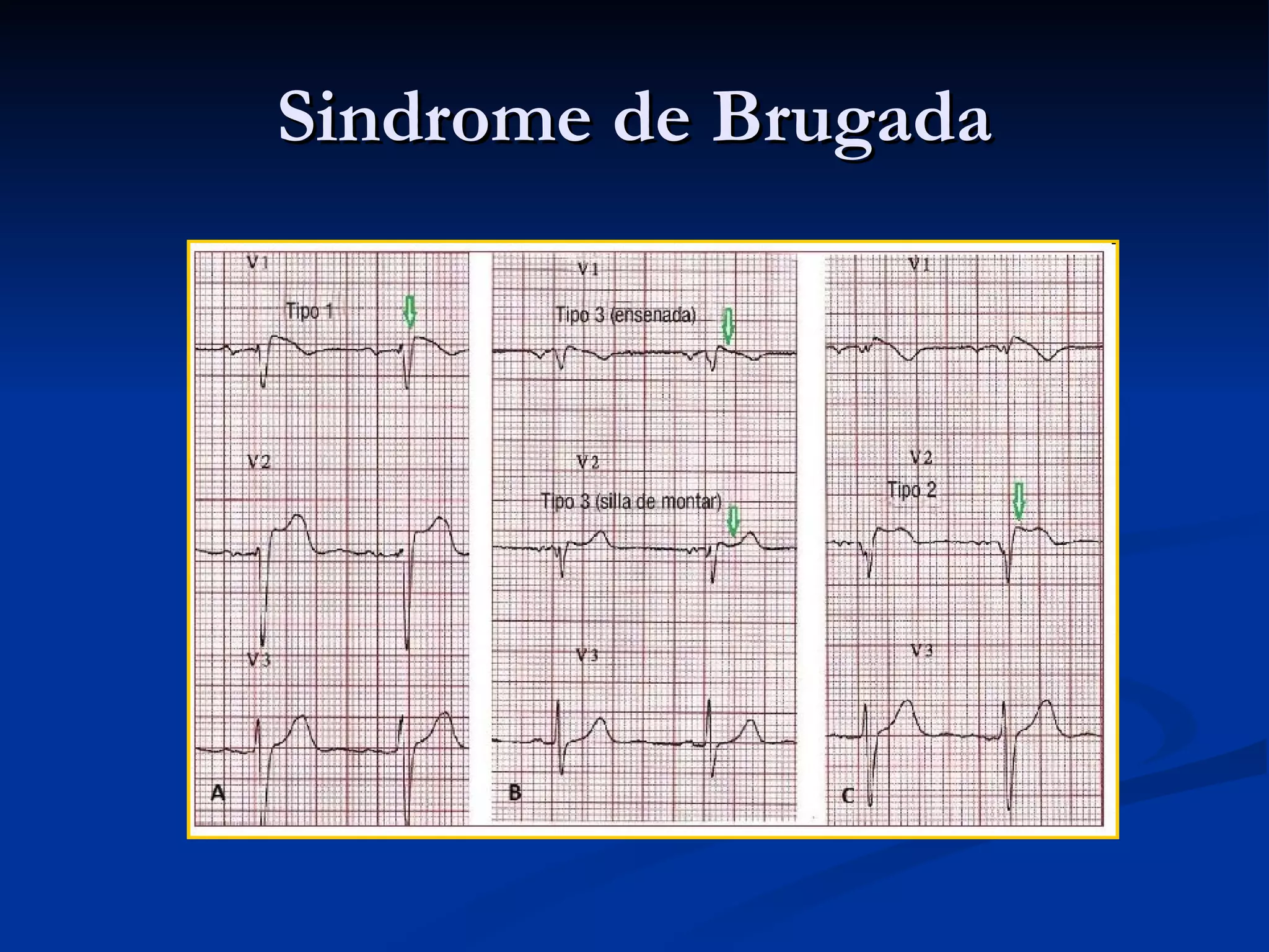 Sindrome de Brugada 