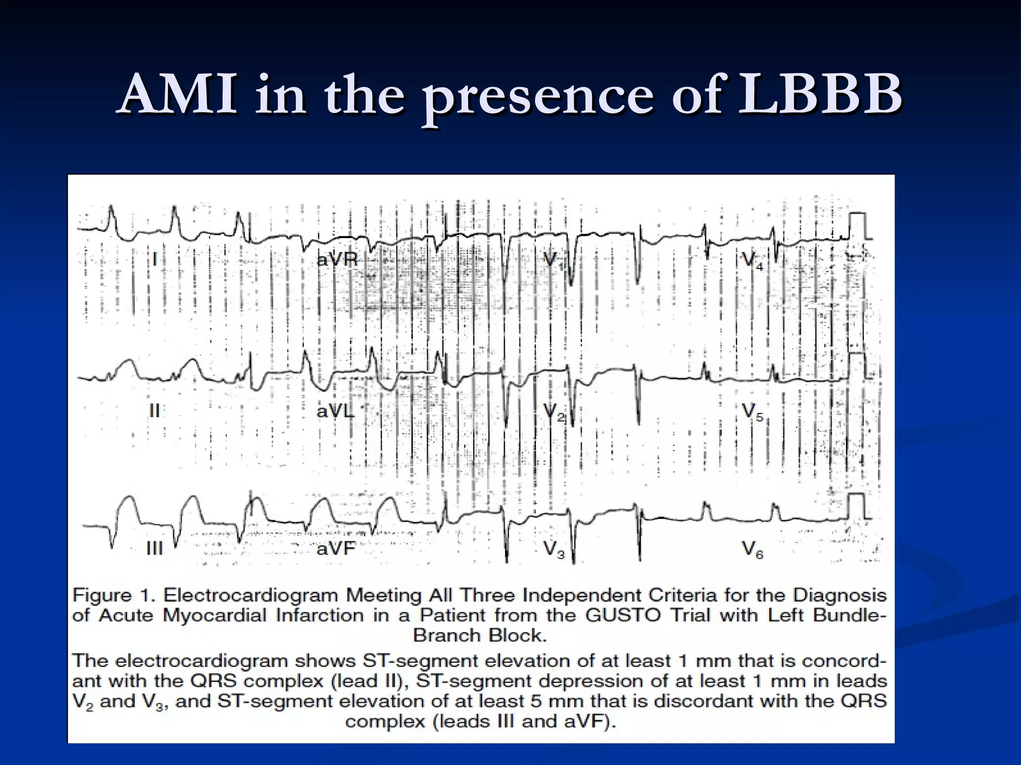 AMI in the presence of LBBB 