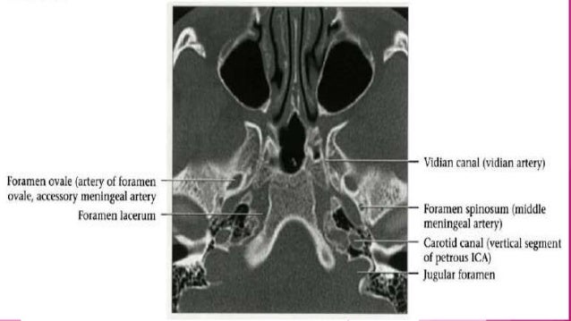 Segments of internal carotid artery
