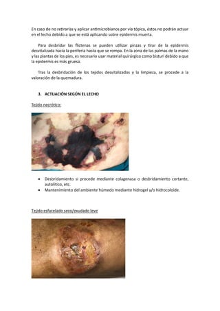 En caso de no reUrarlas y aplicar anUmicrobianos por vía tópica, éstos no podrán actuar
en el lecho debido a que se está aplicando sobre epidermis muerta.
Para desbridar las ﬂictenas se pueden uUlizar pinzas y Urar de la epidermis
desvitalizada hacia la periferia hasta que se rompa. En la zona de las palmas de la mano
y las plantas de los pies, es necesario usar material quirúrgico como bisturí debido a que
la epidermis es más gruesa.
Tras la desbridación de los tejidos desvitalizados y la limpieza, se procede a la
valoración de la quemadura.
3. ACTUACIÓN SEGÚN EL LECHO
Tejido necróUco:
• Desbridamiento si procede mediante colagenasa o desbridamiento cortante,
autolítico, etc.
• Mantenimiento del ambiente húmedo mediante hidrogel y/o hidrocoloide.
Tejido esfacelado seco/exudado leve
 