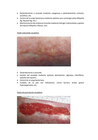 • Desbridamiento si procede mediante colagenasa o desbridamiento cortante,
autolítico, etc.
• Control de la carga bacteriana mediante apósitos que contengan plata (Mepilex
Ag, Aquacel Ag, etc.)
• Mantenimiento del ambiente húmedo mediante hidrogel, hidrocoloide y apósito
de espuma (Mepilex, Allevyn, etc).
Tejido esfacelado exudaUvo
• Desbridamiento si procede.
• GesUón del exudado mediante apósitos absorbentes: alginatos, hidroﬁbras,
apósitos de espuma...
• Control de la carga bacteriana.
• Cuidado de la piel con hidratación, crema barrera, ácidos grasos
hiperoxigenados, etc.
Tejido de granulación exudaUvo
 