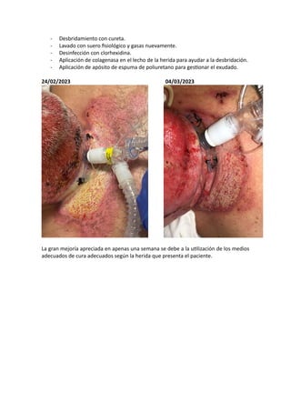 - Desbridamiento con cureta.
- Lavado con suero ﬁsiológico y gasas nuevamente.
- Desinfección con clorhexidina.
- Aplicación de colagenasa en el lecho de la herida para ayudar a la desbridación.
- Aplicación de apósito de espuma de poliuretano para gesUonar el exudado.
24/02/2023 04/03/2023
La gran mejoría apreciada en apenas una semana se debe a la uUlización de los medios
adecuados de cura adecuados según la herida que presenta el paciente.
 