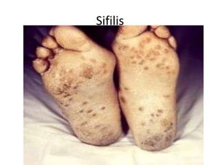 Sifilis
 