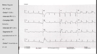 Ritmo: Regular
-FC: 78 lpm
-Onda P: 0.08 s
-Intervalo PR: 0.2 s
-Complejo QRS:
Estrecho
-Intervalo QT: 0.28 s
-Segmento ST:
supradesnivel en V1-
V5
-Onda T: Invertida en
V1-V5
 