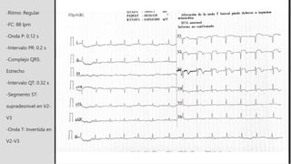 -Ritmo: Regular
-FC: 88 lpm
-Onda P: 0.12 s
-Intervalo PR: 0.2 s
-Complejo QRS:
Estrecho
-Intervalo QT: 0.32 s
-Segmento ST:
supradesnivel en V2-
V3
-Onda T: Invertida en
V2-V3
 