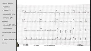 -Ritmo: Regular
-FC: 83 lpm
-Onda P: 0.12 s
-Intervalo PR: 0.2 s
-Complejo QRS:
Estrecho
-Intervalo QT: 0.32 s
-Segmento ST:
supradesnivel en V1-
V4
-Onda T: Invertida en
V1-V5
 