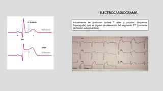 ELECTROCARDIOGRAMA
Inicialmente se producen ondas T altas y picudas (isquemia
hiperaguda) que se siguen de elevación del segmento ST (corriente
de lesión subepicárdica)
 