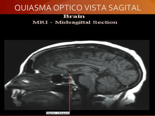 QUIASMA OPTICO VISTA SAGITAL
 